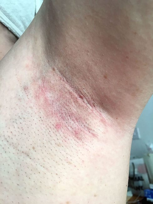 Armpit showing redness after using deodorant