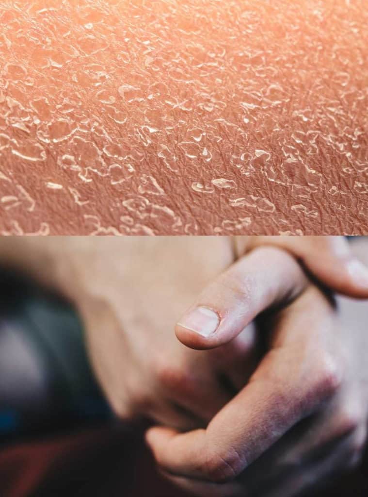 Collage of 2 photos. One photo shows dry skin, the other dry hands.