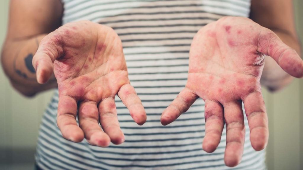 Eczema on hands.