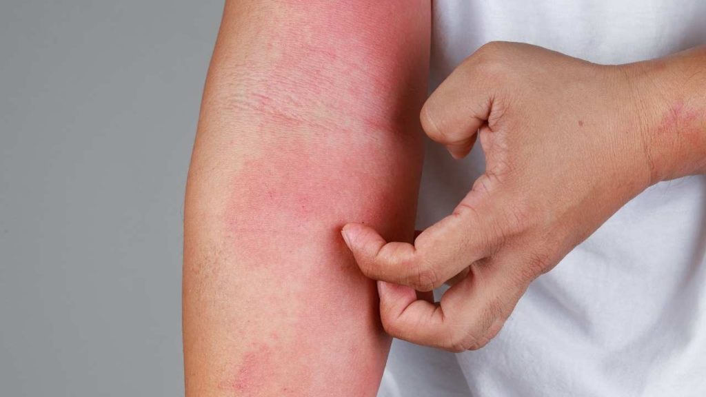 Hand scratching eczema on arma.