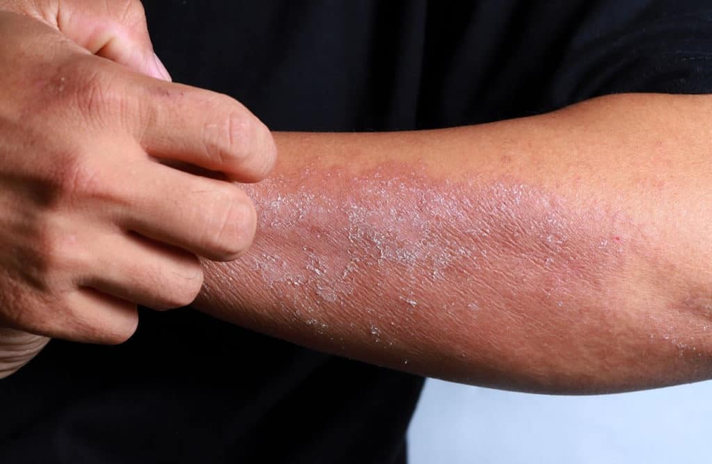 Scratching arm with eczema.
