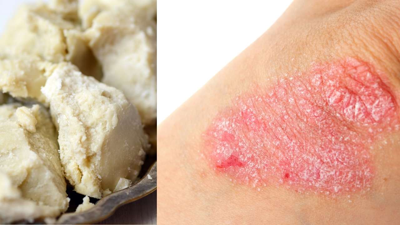 Shea Butter for Eczema | OH. MIGHTY. HEALTH