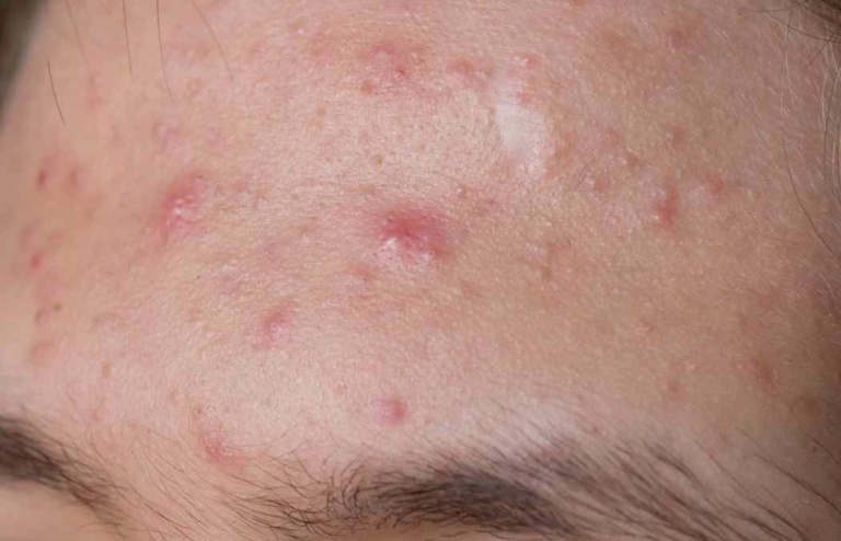 Best Moisturizers for Fungal Acne 2024 [UPDATED]: Safe Options