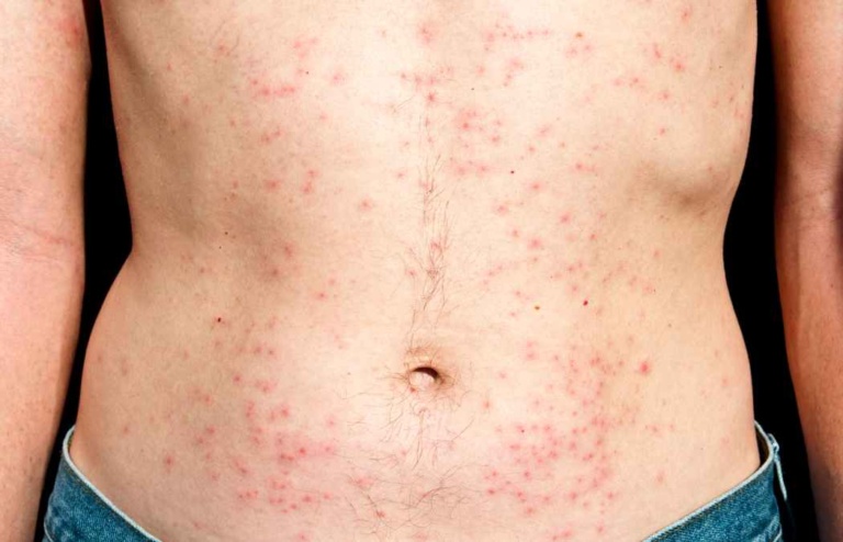 Yeast Folliculitis Symptoms: All About It