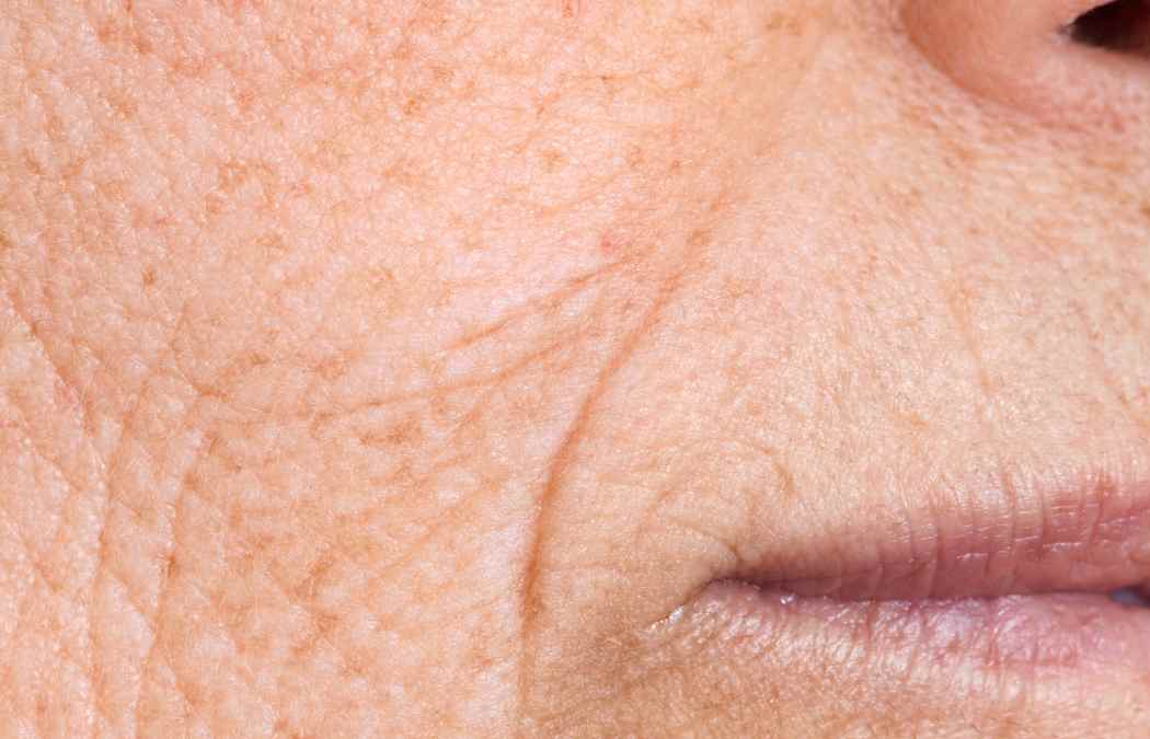 How to Get Rid of Lip Lines: Banish Wrinkles & Smile