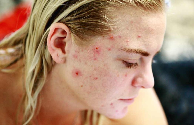Fungal Acne vs Closed Comedones: An In-Depth Guide