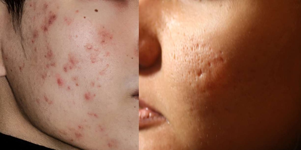 acne marks vs acne scars