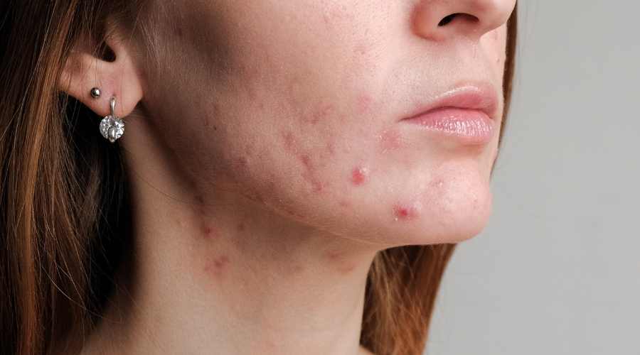 Young lady with fungal acne on side of face