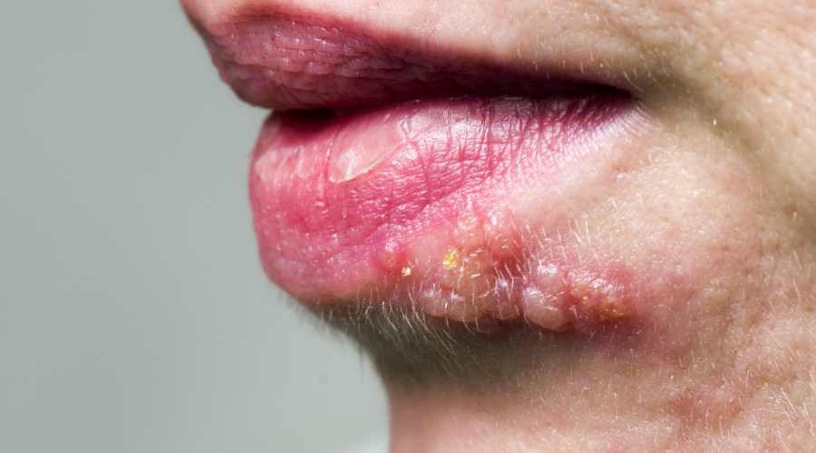 list of diseases aloe vera can treat herpes