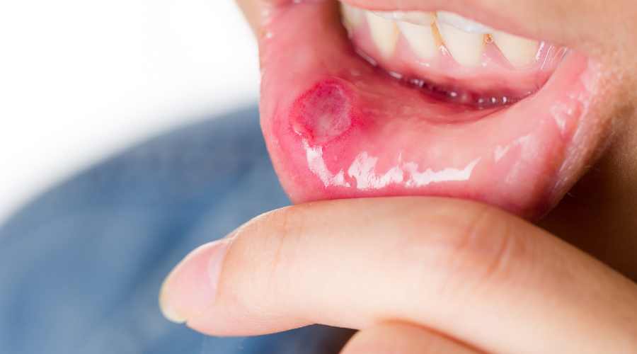 list of diseases aloe vera can treat mouth sores