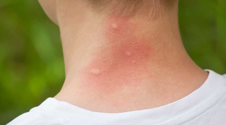 Mosquito bites on neck.