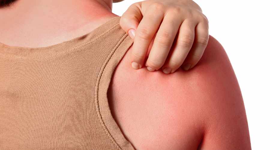 Person scratching sunburned shoulder.