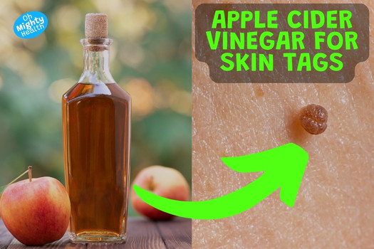 Apple cider vinegar for skin tags.