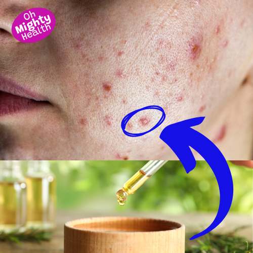 Tea tree oil for acne treatment.