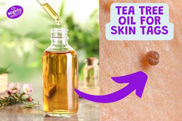 Tea tree oil for skin tags.