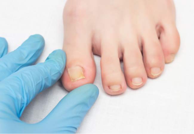 toenail health: splitting or brittle toenails