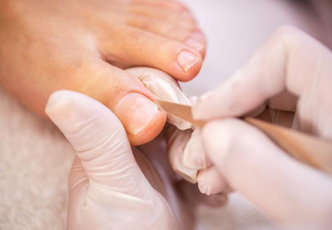 toenail health: ingrown toenails