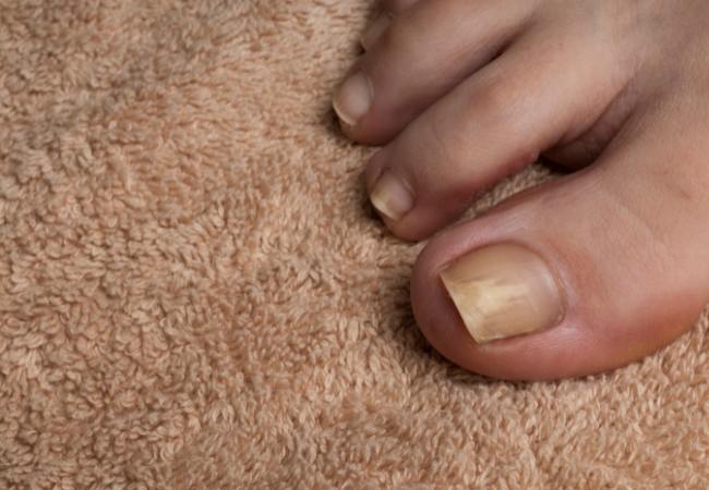 toenail health: yellow toenails